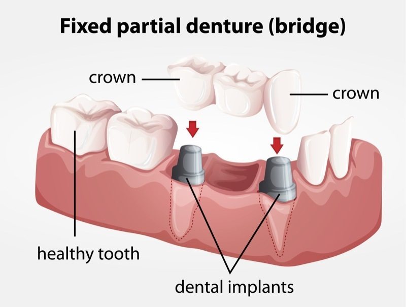 dental-crown-diagram